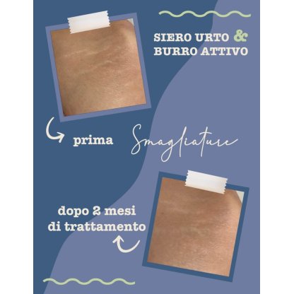 Stretch mark treatment